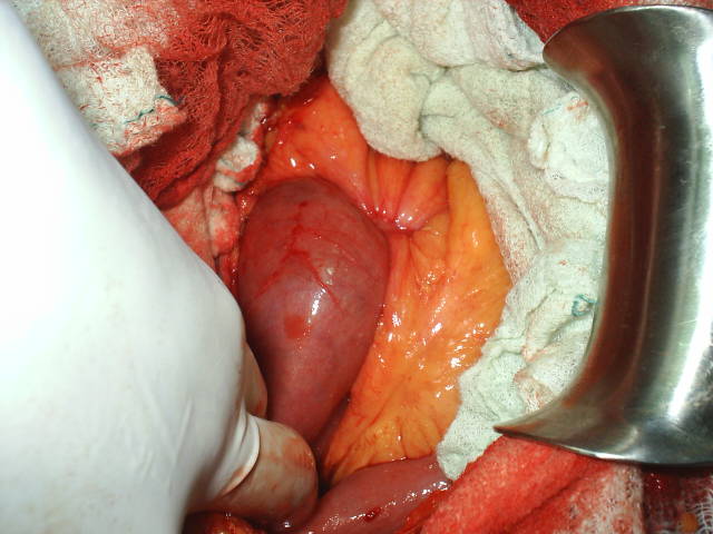 Aspecto transoperatorio del Tumor del Intestino. - <div style=